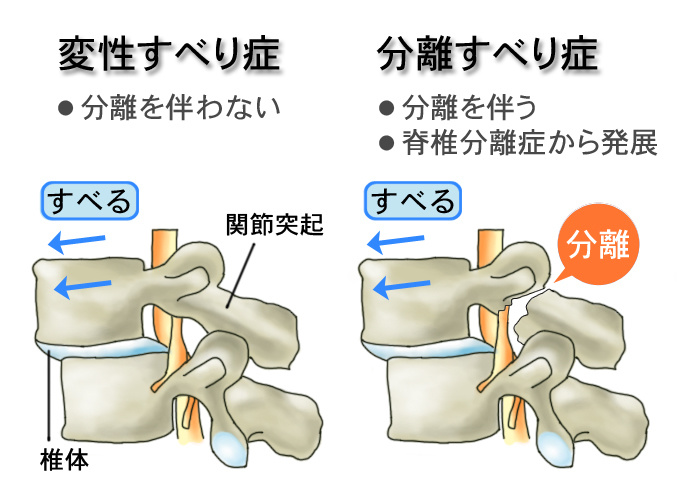 腰椎すべり症 姫路 骨盤本舗group はるき整骨院 みずき整骨院